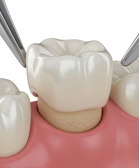 A CGI of a dental crown