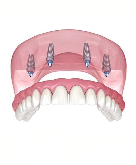 Illustration of an All on 4 denture supported by four dental implants in Goodyear