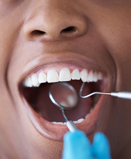 Closeup of woman’s teeth being examined
