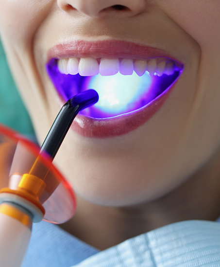 Close up of a woman getting cosmetic dental bonding in Goodyear