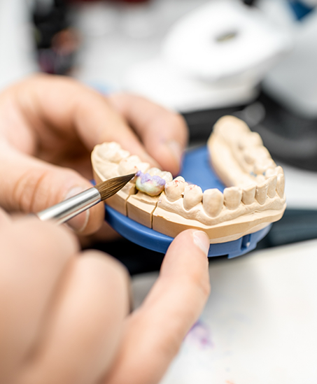 Person adjusting a dental crown in a model of the teeth