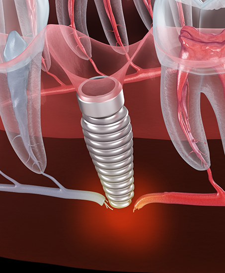 Illustration of a dental implant post in the lower jaw failing