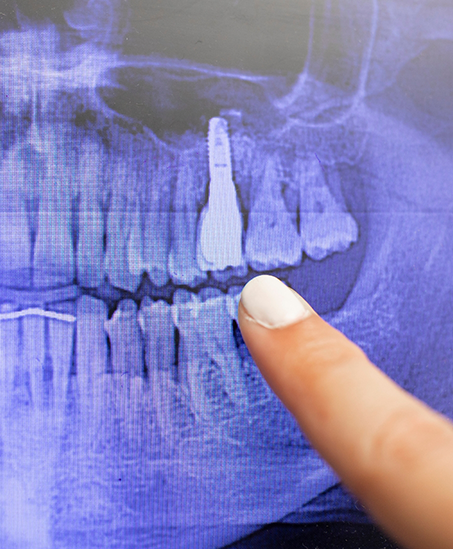 Finger pointing to a dental implant on a dental x ray