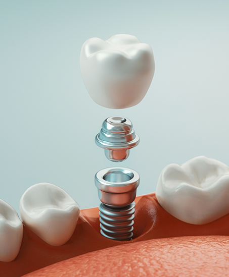 Illustration of a dental implant in Goodyear