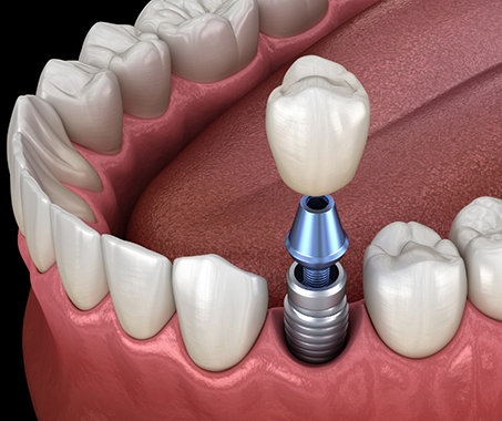 Illustrated dental crown atop a dental implant