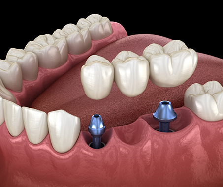 Illustrated dental bridge atop two dental implants