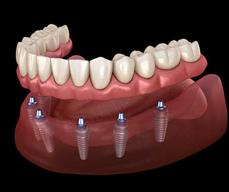Illustrated full denture atop six dental implants
