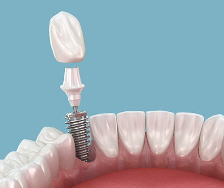 Illustration of a dental implant with crown abd abutment being placed