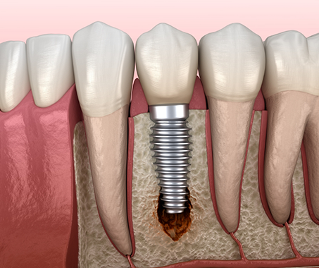 Illustrated dental implant fusing with the lower jawbone