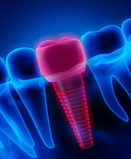 Illustrated x ray of a dental implant