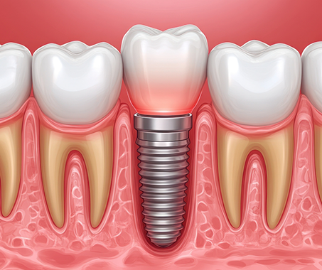 Illustration of a dental implant post in the lower jawbone