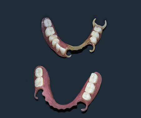 Two partial dentures