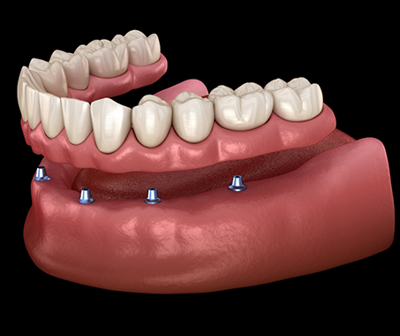 Illustration of a full denture attached to six dental implants