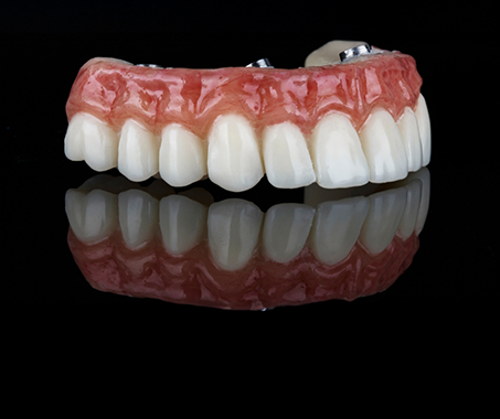 Model of an implant denture