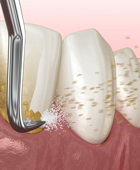 Illustration of a dental scaler clearing tartar buildup from the gumline
