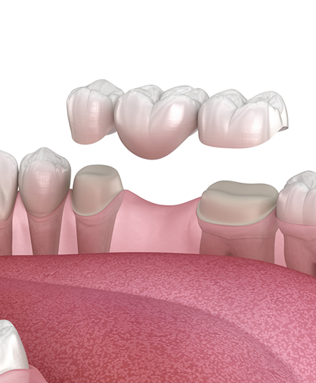 Illustration of a dental bridge replacing a missing tooth in Goodyear