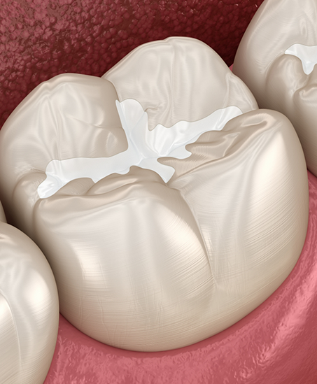 Illustration of a tooth with a white filling