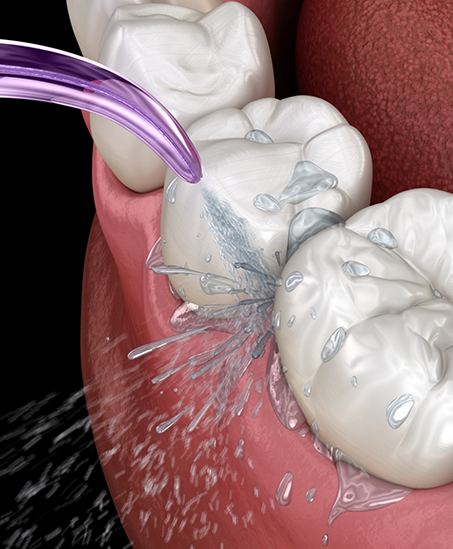 Illustration of teeth receiving a professional cleaning