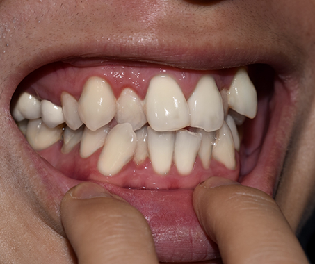 Mouth with crowded teeth