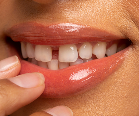 Smile with a small gap between the two front teeth