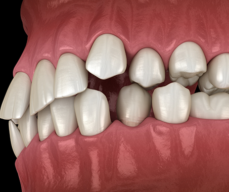 Illustration of a mouth with an overbite