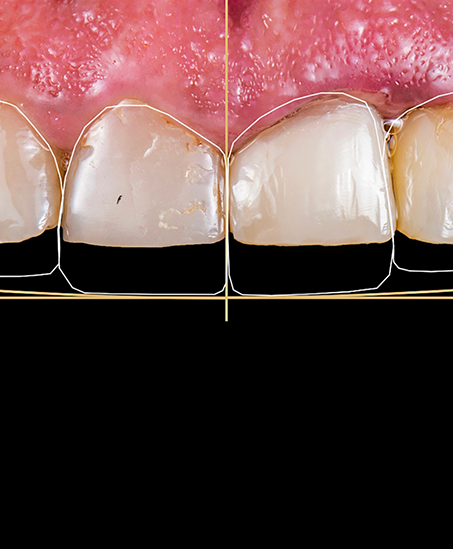 Close up photo of teeth with model lines over them