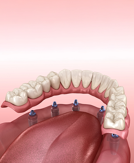 Model of implant dentures in Goodyear