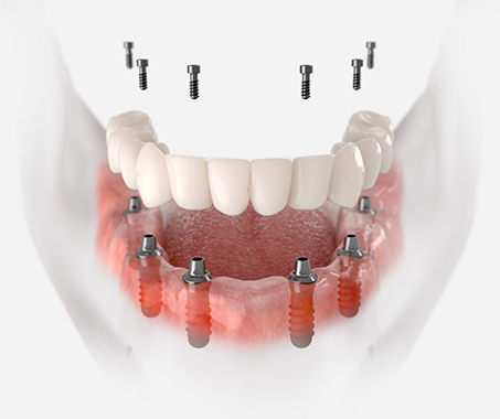 Model of a full denture attached to six dental implants throughout the jaw