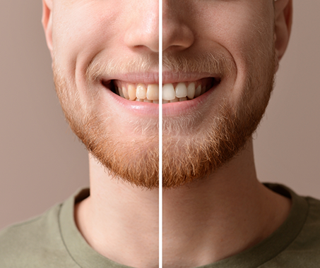 Man smiling before and after teeth whitening