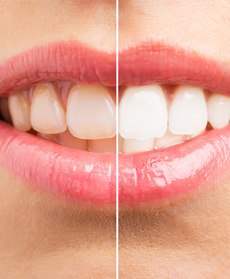 Close up of a smile before and after teeth whitening in Goodyear