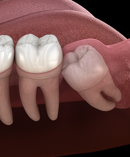 Illustration of an impacted wisdom tooth pressing against the adjacent tooth