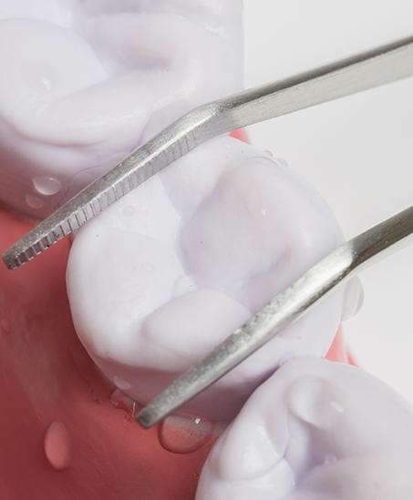 Dental forceps grabbing a tooth to extract it