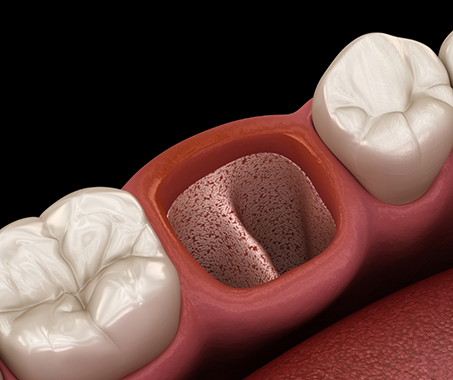 Illustration of an empty socket in the mouth after a tooth extraction