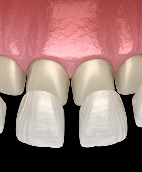 Illustration of veneers covering the upper row of teeth