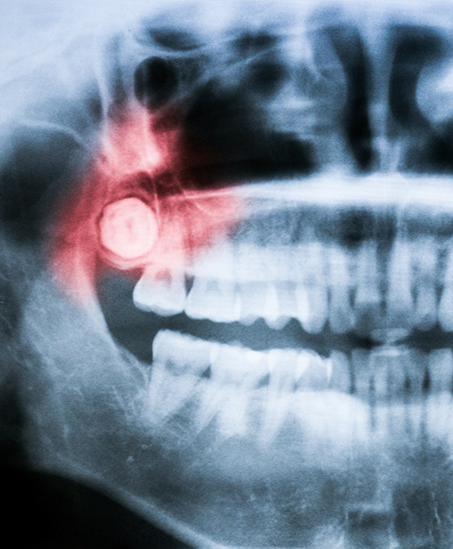 X ray of teeth with an impacted wisdom tooth highlighted red